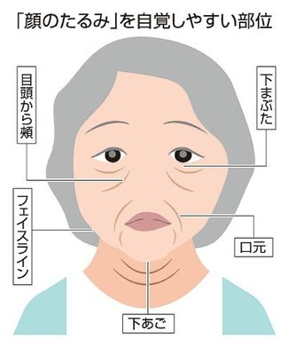 お医者さんに聞いてみよう（４１）<br />顔のたるみが気になる　佐武利彦さん（富山大付属病院形成再建外科・美容外科診療部門長）