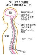 脳の難病患者に遺伝子治療