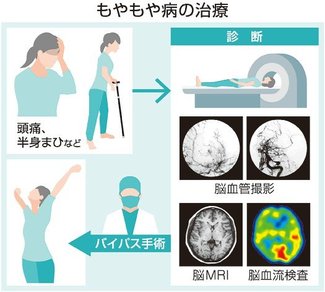 お医者さんに聞いてみよう（３６）<br />「もやもや病」とは？　黒田敏さん（富山大付属病院脳神経外科診療部門長）
