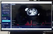 けがＣＴ画像、１０秒でＡＩ分析