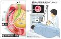 胃カメラ検査で膵がん診断、阪大