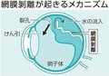 お医者さんに聞いてみよう（２８）<br />網膜剥離になったらどうする？　柳澤秀一郎さん（富山大付属病院眼科診療教授）