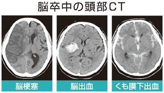 お医者さんに聞いてみよう（５０）<br />脳卒中 気を付けることは？　黒田敏さん（富山大付属病院脳神経外科診療部門長）
