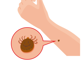 マダニ感染症どう防ぐ？ 国内で死亡例も　平野部でも要注意、上着の袖・ズボンの裾は「イン！」