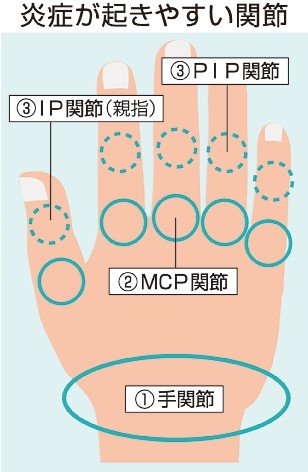 お医者さんに聞いてみよう（３７）<br />リウマチについて知りたい　加藤将さん（富山大付属病院第一内科診療部門長）
